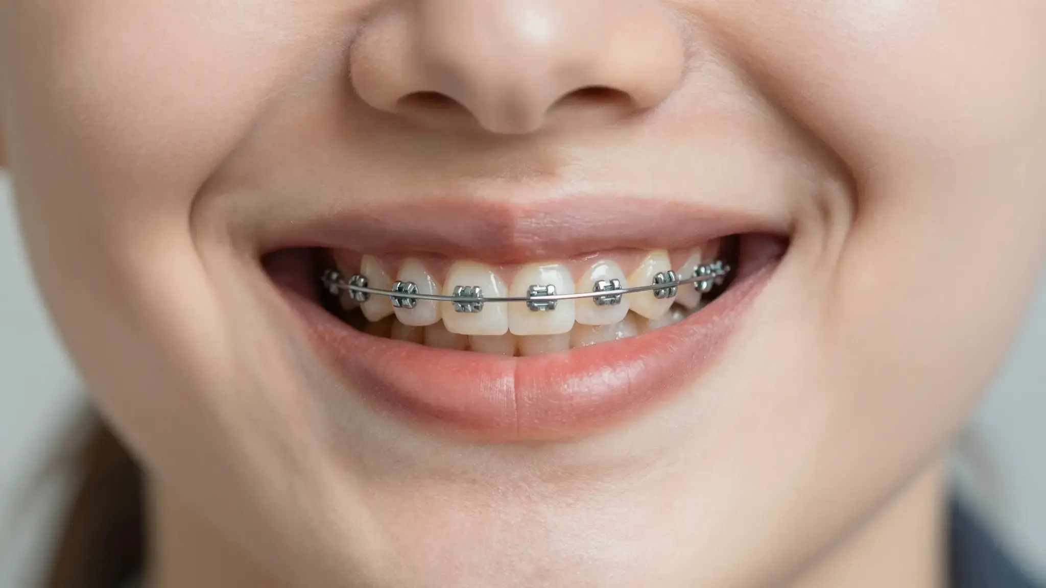 Vista previa de Filtro de brackets con IA